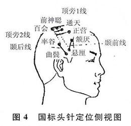 耳针、头针及眼针法禁忌