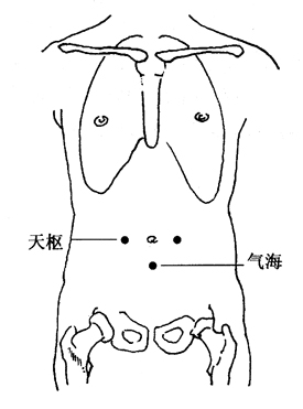 小儿遗尿的拔罐疗法